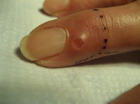 Pictures of Mucous Cyst in Finger - Raleigh Hand to Shoulder Center ...