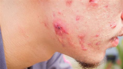 Cystic Acne 101: Causes and Treatments - Medicine.com