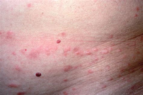 What’s Eating You? Human Body Lice (Pediculus humanus corporis) | MDedge Dermatology