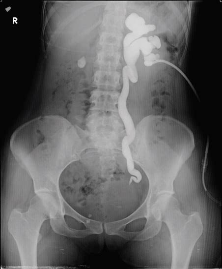 Retrograde Pyelogram - servefasr