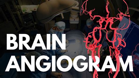 Angiogram - BRAIN angio procedure video - YouTube