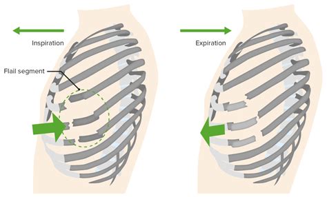 Flail Chest | Concise Medical Knowledge