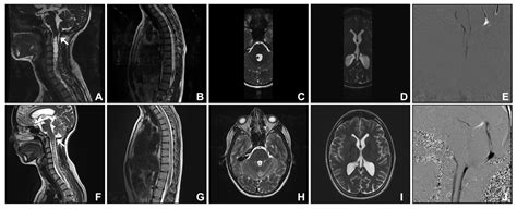 JCM | Free Full-Text | Cerebellar Tonsillar Descent Mimicking Chiari Malformation