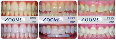 zoom teeth whitening near me cost Smile gallery leardi family dentistry