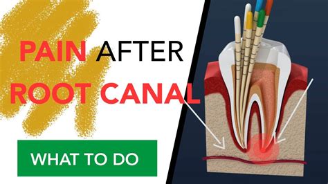 Pain After Root Canal | WHAT TO DO - YouTube