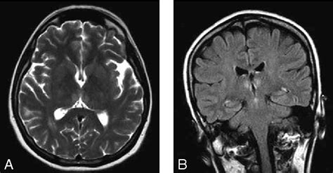 Figure 1 from Wernicke's encephalopathy: a case report and MRI findings ...