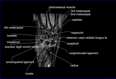 Wrist Ligaments Mri