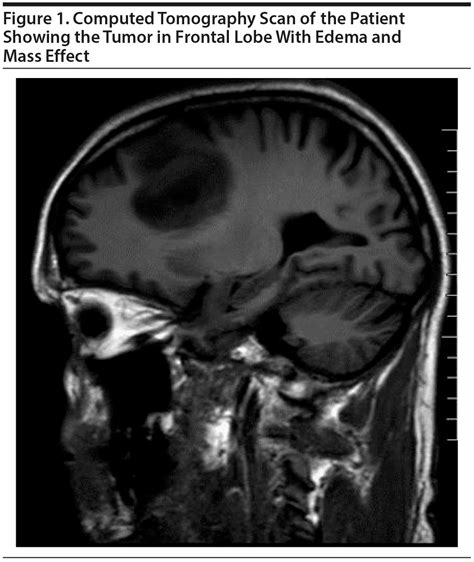 Delayed Diagnosis of Glioblastoma Multiforme Presenting With Atypical ...