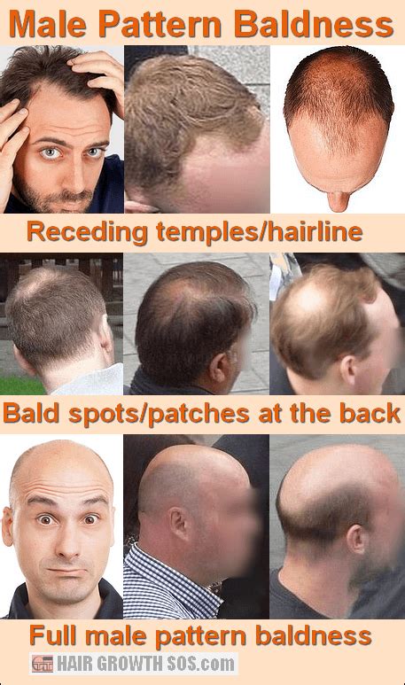 45++ Causes of hair thinning in men Wallpaper | quickhairstyles