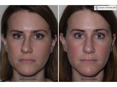 Septoplasty and Rhinoplasty for Sinus symptoms