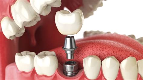 Titanium Dental Implants: Why They are Superior | Dental Implants