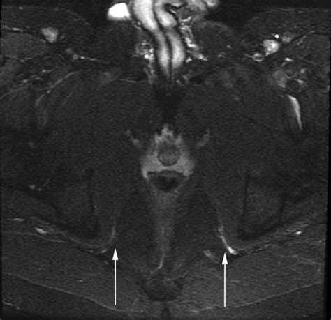 Pudendal nerve entrapment between the ischial spine and the Alcock ...