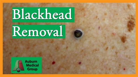 Giant Blackheads Removal