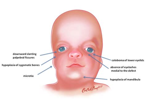 10 Facts About Treacher Collins Syndrome - Listupon