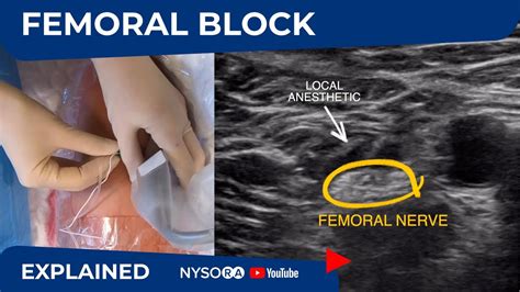 Genitofemoral Nerve Block Ultrasound