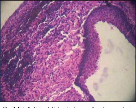 Figure 3 from Quiste globulomaxilar de localización inusual: Reporte de un caso An unusual case ...