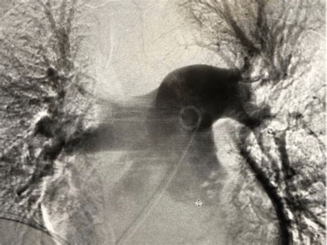 Successful Mechanical Thrombectomy for Pulmonary Embolism Using the ...