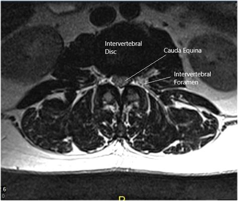 Case Study: Management of 50-year-old male with Cauda Equina Syndrome