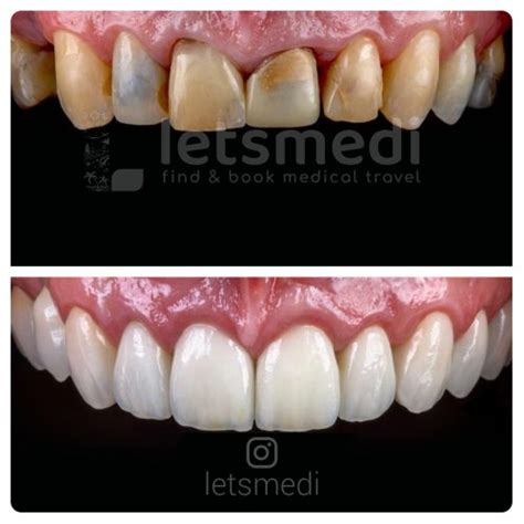 Zirconium Crown in Turkey - Letsmedi