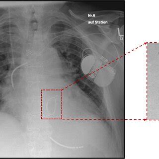 (PDF) Case series of late complications after transcatheter mitral ...