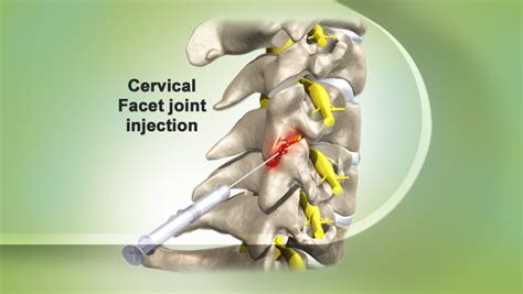 Facet Joint Injection- Indications and Complications | Bone and Spine