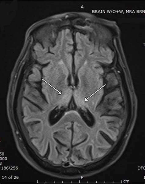 Southwest Journal of Pulmonary, Critical Care and Sleep - Imaging ...