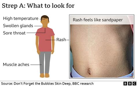 What is strep A and what are the symptoms?