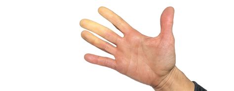 Raynaud’s disease- Causes, Symptoms and Treatment