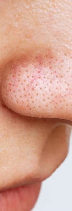 What are sebaceous filaments and how to get rid of them? - alkmene