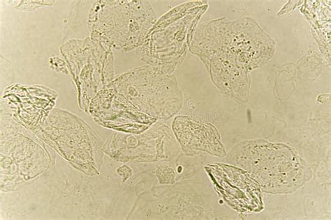 Epithelial Cells In Urine