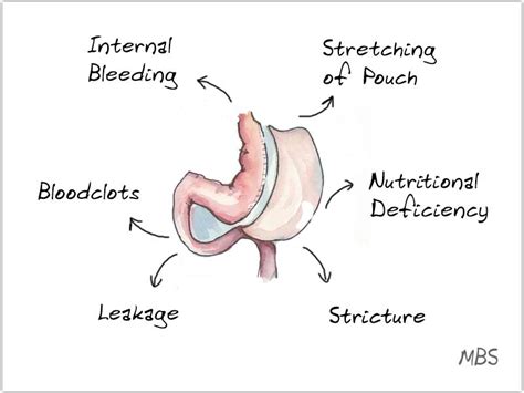 7 Gastric Sleeve Risks and Remedies