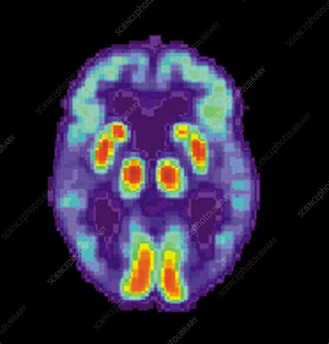 PET Scan of Alzheimer's Disease Brain - Stock Image - C017/4474 ...