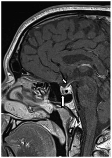 Pituitary apoplexy without chiasm compression: A case report