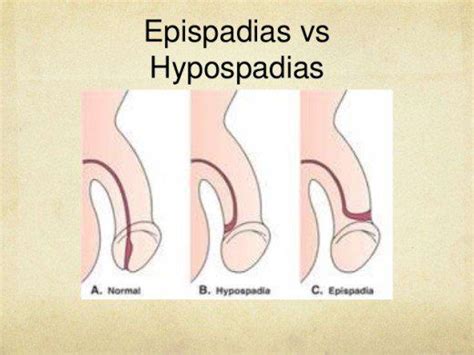 Epispadias And Hypospadias