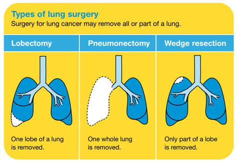 Lung cancer treatment - Cancer Council Victoria