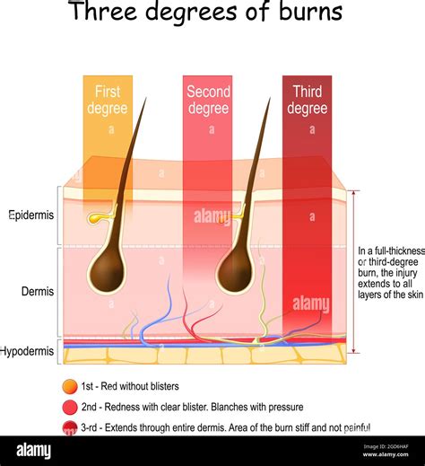 Skin Burn Three Degrees Of Burns Type Of Injury Vecto - vrogue.co