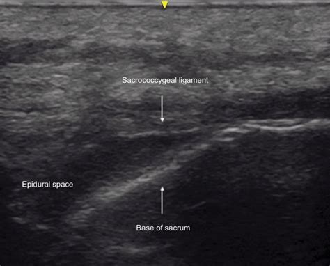 Longitudinal image of the sacrum showing the sacrococcygeal ligament,... | Download Scientific ...