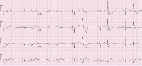 Carolinas EKG Blog - CMC COMPENDIUM