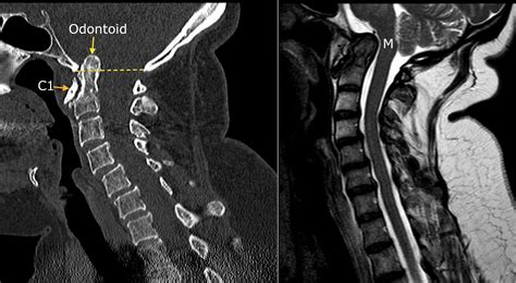 Basilar impression - Radiology at St. Vincent's University Hospital