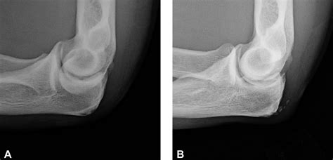 Surgical Management of Symptomatic Olecranon Traction Spurs - Hasham M. Alvi, David M. Kalainov ...