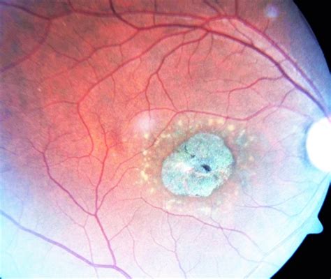 Macular Dystrophy - Retina Image Bank