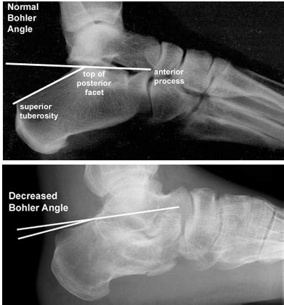 Anterior Calcaneus Fracture