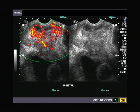 Ultrasound and Color Doppler videos: Prostate -transrectal ultrasound quiz