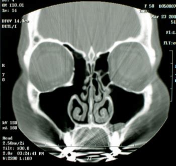 Sinusitis Treatment and Surgery NYC | Case Studies