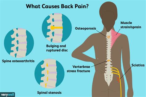 Back Pain: Causes, Treatment, and When to See a Healthcare Provider