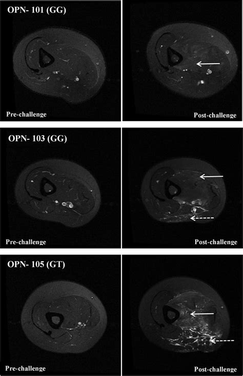 T2-weighted MRI images of young adult females carrying the G allele of ...