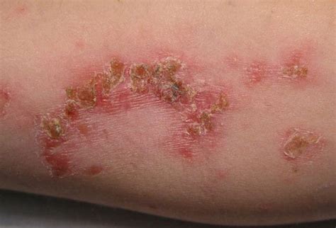 bacterial skin rash - pictures, photos