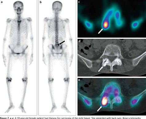 Spect Ct Scan