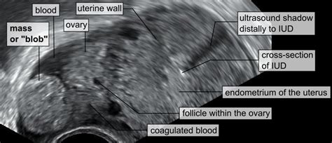 Ectopic Pregnancy - Rupture - Symptoms - Management - TeachMeObGyn