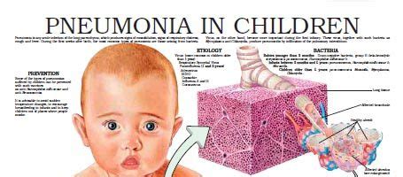 Pneumonia in children – Anejo